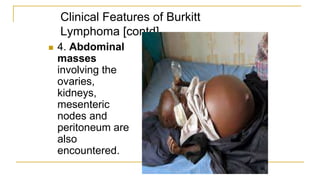 Clinical Features of Burkitt
Lymphoma [contd].
 4. Abdominal
masses
involving the
ovaries,
kidneys,
mesenteric
nodes and
peritoneum are
also
encountered.
 