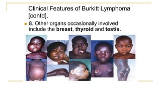Clinical Features of Burkitt Lymphoma
[contd].
 8. Other organs occasionally involved
include the breast, thyroid and testis.
 