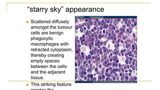 “starry sky” appearance
 Scattered diffusely
amongst the tumour
cells are benign
phagocytic
macrophages with
retracted cytoplasm,
thereby creating
empty spaces
between the cells
and the adjacent
tissue.
 This striking feature
 