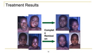 Treatment Results
Complet
e
Remissi
on
62
 