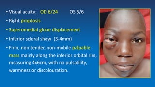 • Visual acuity: OD 6/24 OS 6/6
• Right proptosis
• Superomedial globe displacement
• Inferior scleral show (3-4mm)
• Firm, non-tender, non-mobile palpable
mass mainly along the inferior orbital rim,
measuring 4x6cm, with no pulsatility,
warmness or discolouration.
 