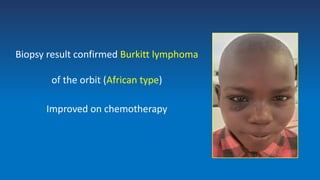 Biopsy result confirmed Burkitt lymphoma
of the orbit (African type)
Improved on chemotherapy
 