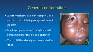 General considerations
• Burkitt lymphoma is a non-Hodgkin B-cell
lymphoma that is being recognised more in
the orbit
• Rapidly progressive, solid lymphoma with
a predilection for the jaw and abdomen
• 50% of childhood malignant tumors in East
Africa
 