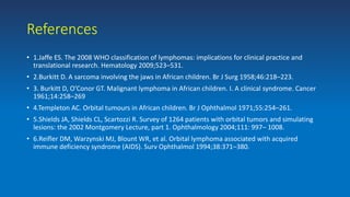 References
• 1.Jaffe ES. The 2008 WHO classification of lymphomas: implications for clinical practice and
translational research. Hematology 2009;523–531.
• 2.Burkitt D. A sarcoma involving the jaws in African children. Br J Surg 1958;46:218–223.
• 3. Burkitt D, O’Conor GT. Malignant lymphoma in African children. I. A clinical syndrome. Cancer
1961;14:258–269
• 4.Templeton AC. Orbital tumours in African children. Br J Ophthalmol 1971;55:254–261.
• 5.Shields JA, Shields CL, Scartozzi R. Survey of 1264 patients with orbital tumors and simulating
lesions: the 2002 Montgomery Lecture, part 1. Ophthalmology 2004;111: 997– 1008.
• 6.Reifler DM, Warzynski MJ, Blount WR, et al. Orbital lymphoma associated with acquired
immune deficiency syndrome (AIDS). Surv Ophthalmol 1994;38:371–380.
 