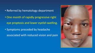 • Referred by hematology department
• One month of rapidly progressive right
eye proptosis and lower eyelid swelling.
• Symptoms preceded by headache
associated with reduced vision and pain
 