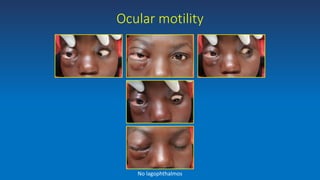 Ocular motility
No lagophthalmos
 
