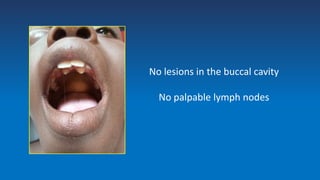 No lesions in the buccal cavity
No palpable lymph nodes
 