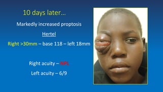 10 days later…
Markedly increased proptosis
Hertel
Right >30mm – base 118 – left 18mm
Right acuity – NPL
Left acuity – 6/9
 