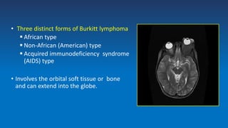 • Three distinct forms of Burkitt lymphoma
 African type
 Non-African (American) type
 Acquired immunodeficiency syndrome
(AIDS) type
• Involves the orbital soft tissue or bone
and can extend into the globe.
 