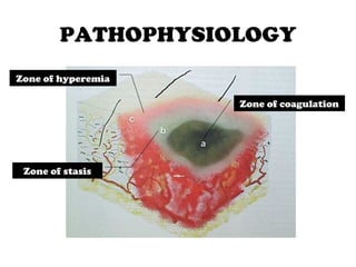 PATHOPHYSIOLOGY
Zone of coagulation
Zone of stasis
Zone of hyperemia
 