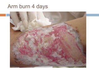 Extraction Burn Burn | PPTX
