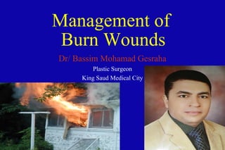Management of
Burn Wounds
Dr/ Bassim Mohamad Gesraha
Plastic Surgeon
King Saud Medical City

 