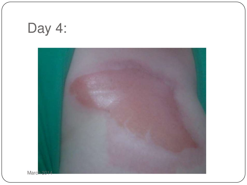 Second Degree Burnheating water in the microwave