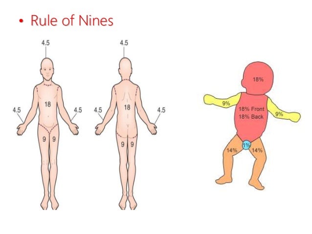 Rule Of Nines Burn Chart
