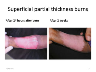 Superficial partial thickness burns
After 24 hours after burn After 2 weeks
10/22/2016 23
 