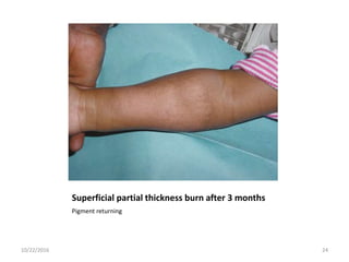 Superficial partial thickness burn after 3 months
Pigment returning
10/22/2016 24
 