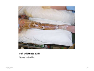 Full thickness burn
Wraped in cling film
10/22/2016 28
 