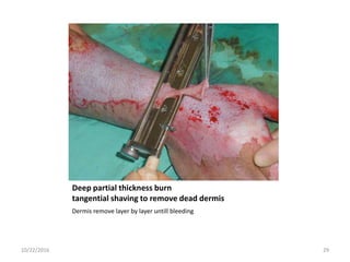 Deep partial thickness burn
tangential shaving to remove dead dermis
Dermis remove layer by layer untill bleeding
10/22/2016 29
 