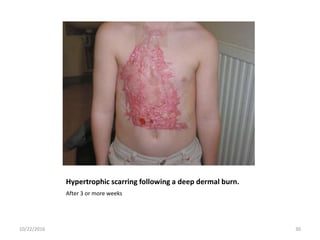 Hypertrophic scarring following a deep dermal burn.
After 3 or more weeks
10/22/2016 30
 