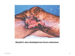 Marjolin’s ulcer developed over burns contracture
10/22/2016 57
 