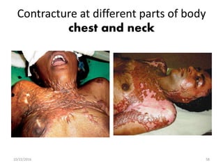 Contracture at different parts of body
chest and neck
10/22/2016 58
 