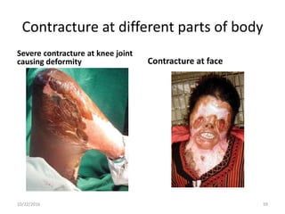 Contracture at different parts of body
Severe contracture at knee joint
causing deformity Contracture at face
10/22/2016 59
 