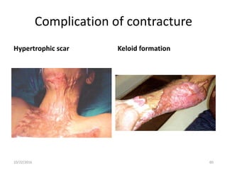 Complication of contracture
Hypertrophic scar Keloid formation
10/22/2016 60
 