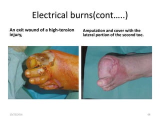 Electrical burns(cont…..)
An exit wound of a high-tension
injury,
Amputation and cover with the
lateral portion of the second toe.
10/22/2016 68
 