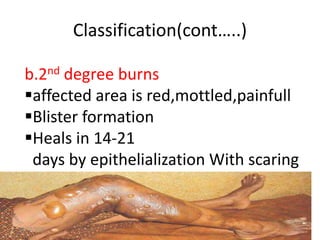 Classification(cont…..)
b.2nd degree burns
affected area is red,mottled,painfull
Blister formation
Heals in 14-21
days by epithelialization With scaring
10/22/2016 9
 