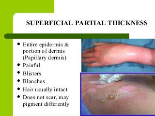 SUPERFICIAL PARTIAL THICKNESS
 Entire epidermis &
portion of dermis
(Papillary dermis)
 Painful
 Blisters
 Blanches
 Hair usually intact
 Does not scar, may
pigment differently
 