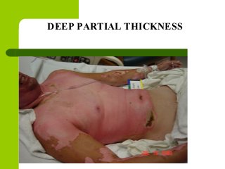 DEEP PARTIAL THICKNESS
 