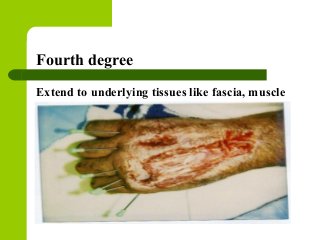 Fourth degree
Extend to underlying tissues like fascia, muscle
 