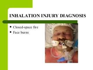 INHALATION INJURY DIAGNOSIS
 Closed-space fire
 Face burns
 