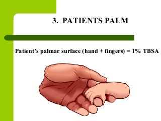 3. PATIENTS PALM
Patient’s palmar surface (hand + fingers) = 1% TBSAPatient’s palmar surface (hand + fingers) = 1% TBSA
 