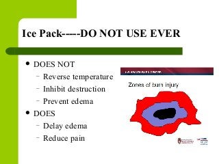 Ice Pack-----DO NOT USE EVER
 DOES NOT
– Reverse temperature
– Inhibit destruction
– Prevent edema
 DOES
– Delay edema
– Reduce pain
 