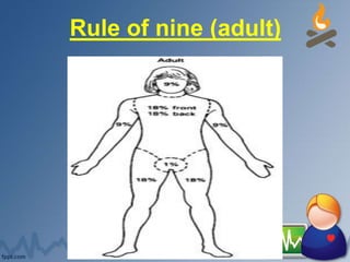 Rule of nine (adult)
 