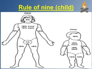 Rule of nine (child)
 