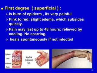 Slight Burn In Burn | PPT