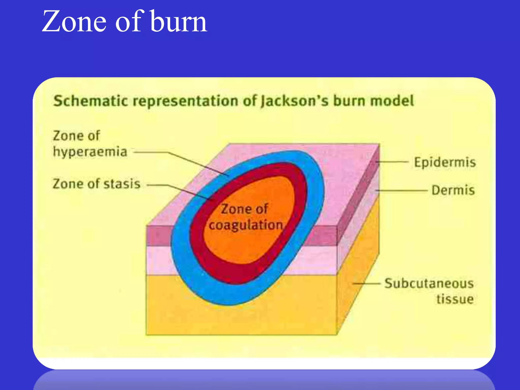 Zone of burn
 