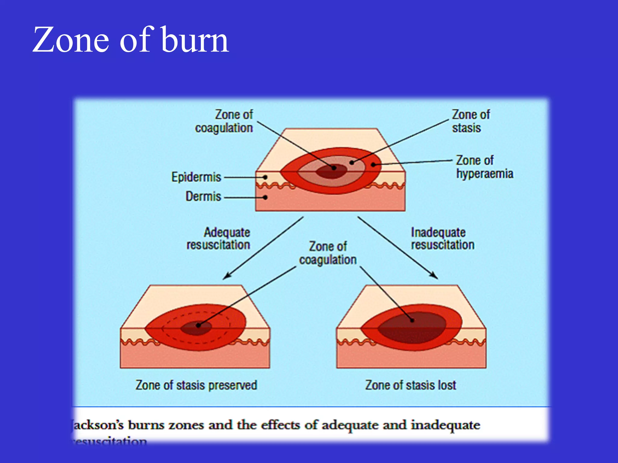 Zone of burn
 