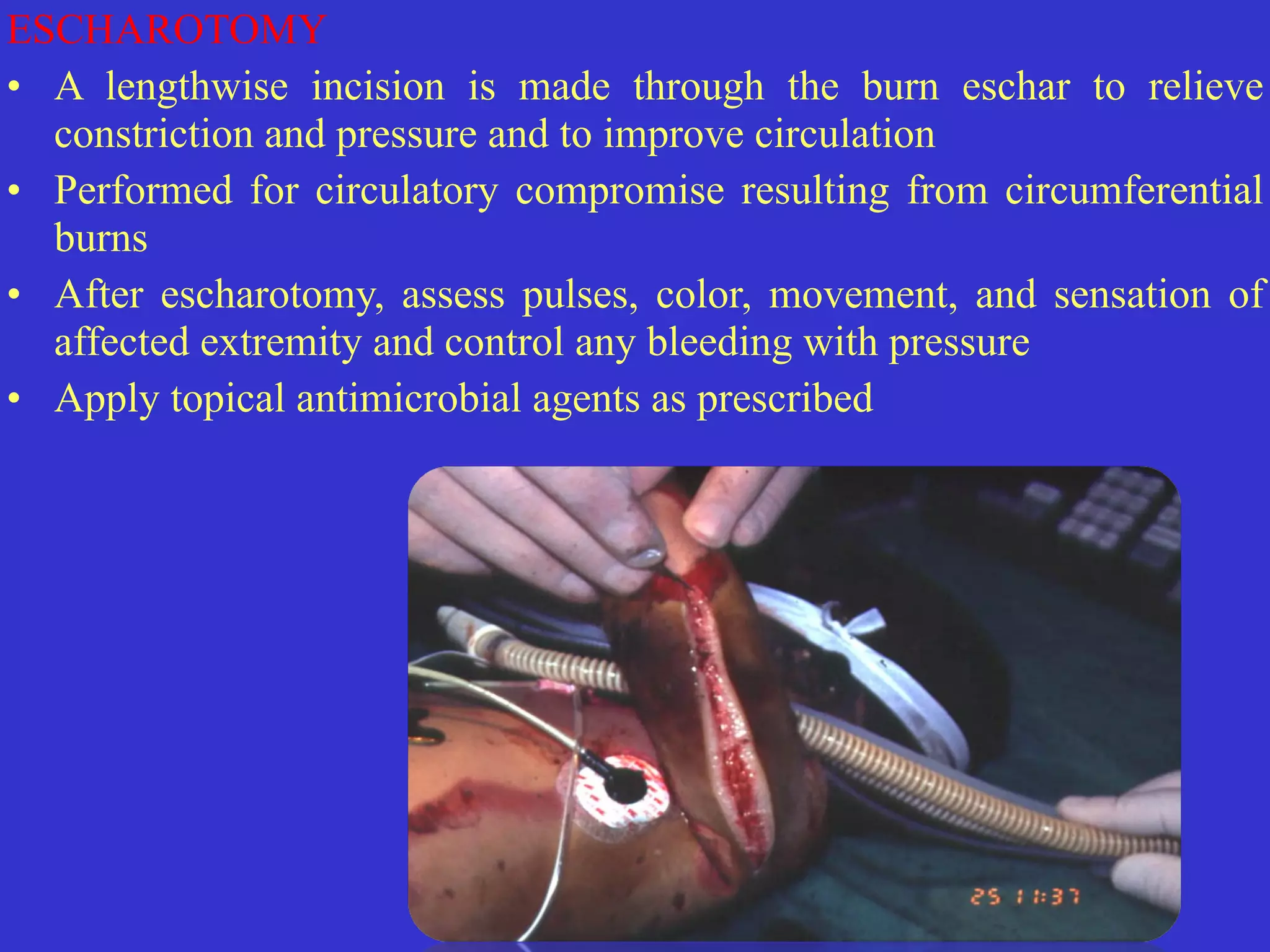 ESCHAROTOMY


• A lengthwise incision is made through the burn eschar to relieve
constriction and pressure and to improve circulation


• Performed for circulatory compromise resulting from circumferential
burns


• After escharotomy, assess pulses, color, movement, and sensation of
affected extremity and control any bleeding with pressure


• Apply topical antimicrobial agents as prescribed
 