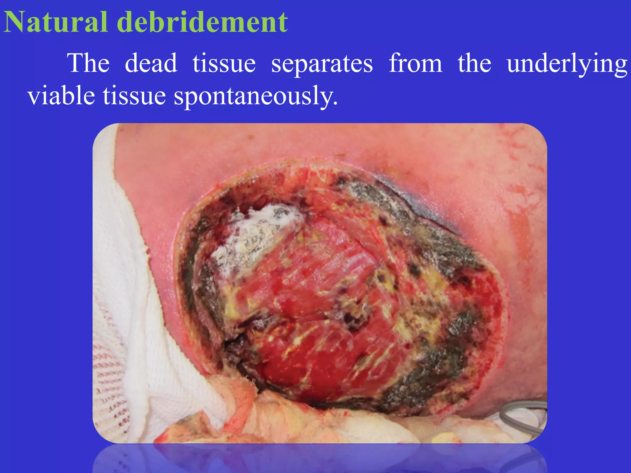 Natural debridement


	
	
The dead tissue separates from the underlying
viable tissue spontaneously.
 