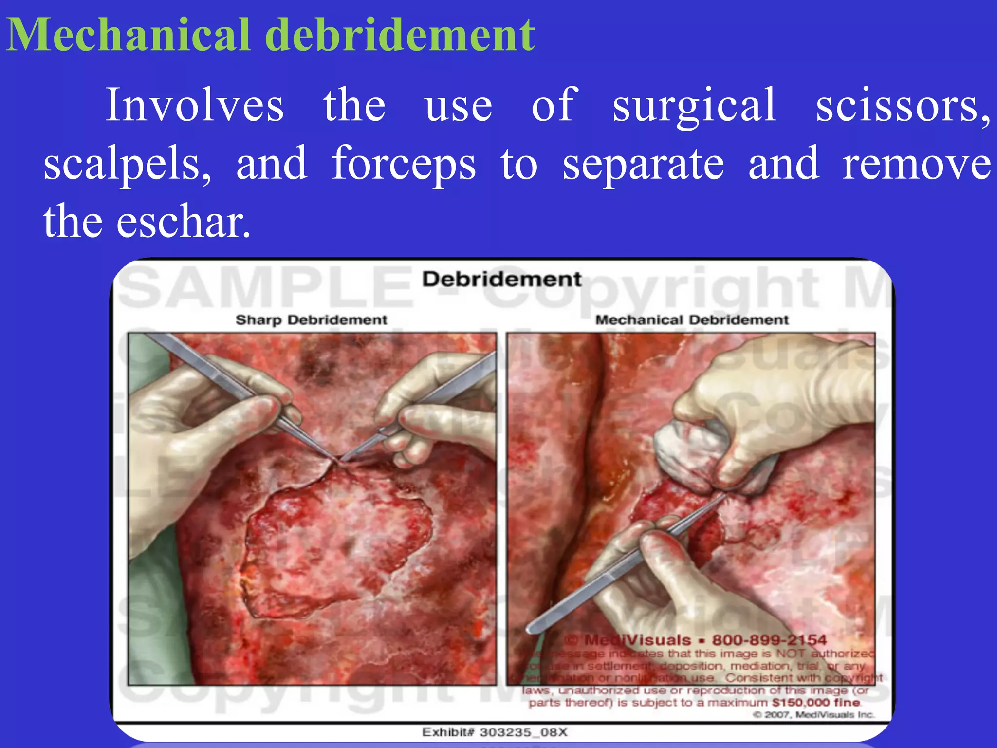 Mechanical debridement


	
	
Involves the use of surgical scissors,
scalpels, and forceps to separate and remove
the eschar.
 