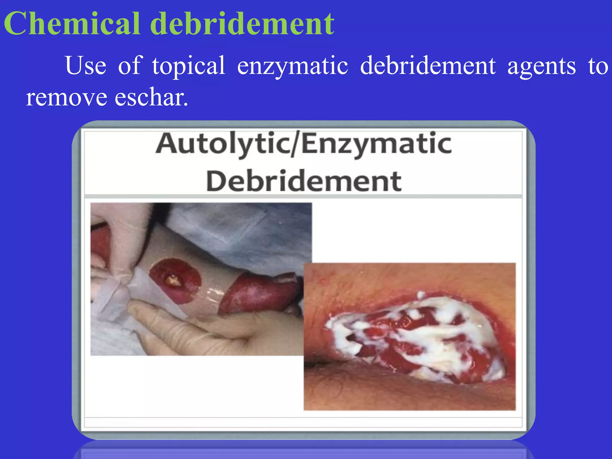 Chemical debridement


	
	
Use of topical enzymatic debridement agents to
remove eschar.
 