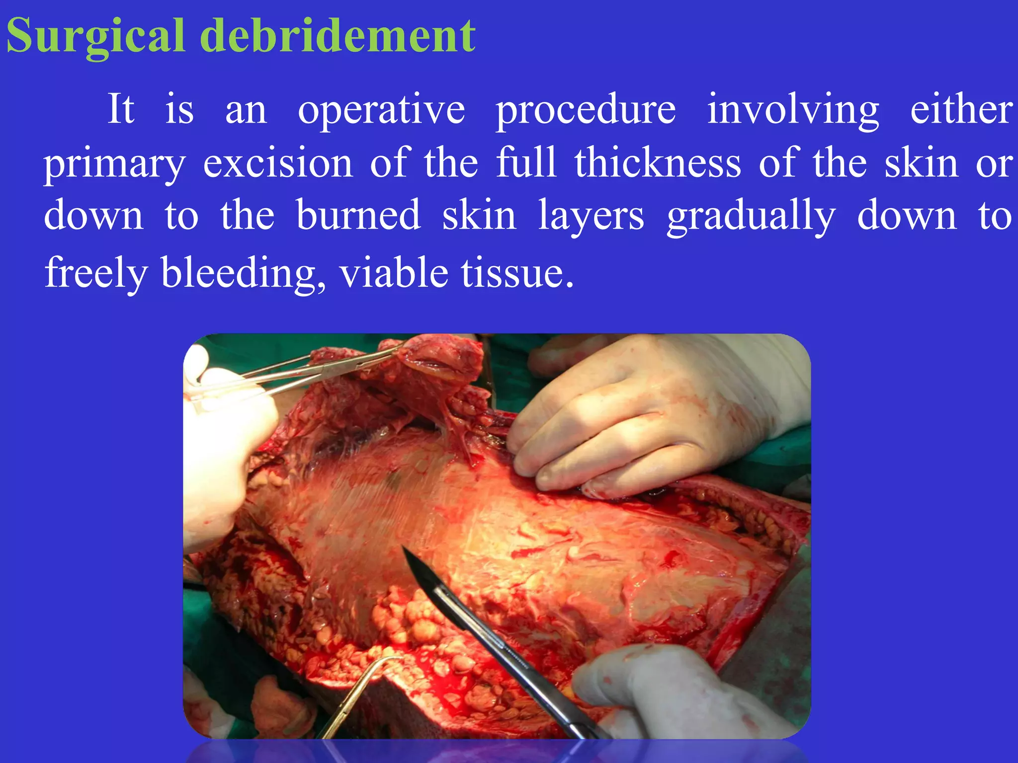 Surgical debridement


	
	
It is an operative procedure involving either
primary excision of the full thickness of the skin or
down to the burned skin layers gradually down to
freely bleeding, viable tissue.
 