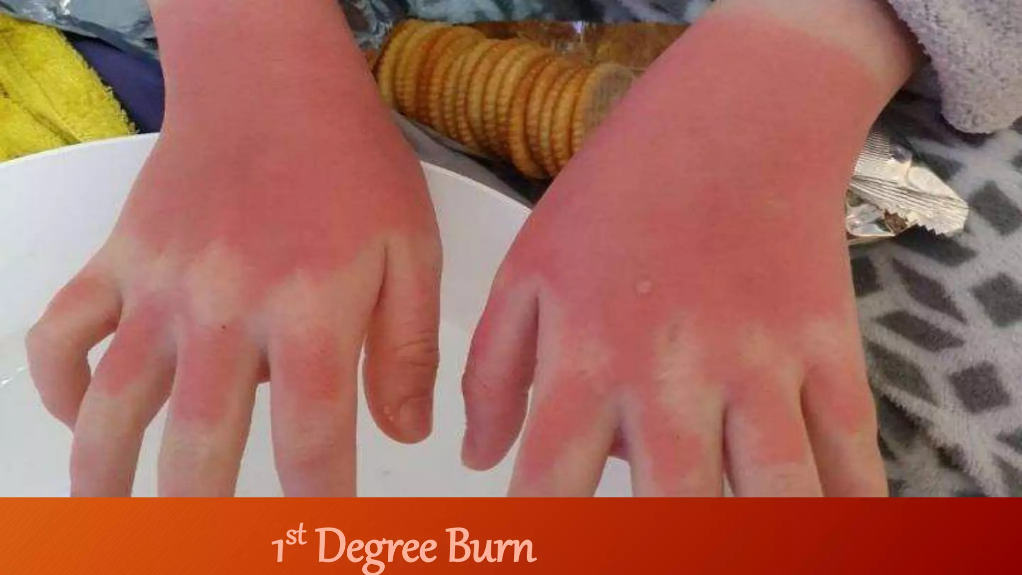 1st Degree Burn
 