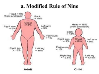 a. Modified Rule of Nine
 