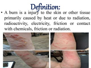 Definition:
• A burn is a injury to the skin or other tissue
primarily caused by heat or due to radiation,
radioactivity, electricity, friction or contact
with chemicals, friction or radiation.
 