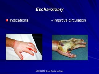 Burn diagnostic and treatement in all .ppt.. | PPT