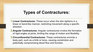 Contractures Examples Burn & its Management for Nurses And Faculty of Nursing.pptx